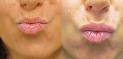 Perma Lip Implant for the Upper Lip of this 37 Year Old Woman - This 37 year old woman underwent placement of a 4 mm x 60 mm soft, pliable Perma Lip Implant for the upper lip only. The procedure was done in the office under local anesthesia . The procedure took 20 minutes and was done on a Friday. She returned to work on Monday.