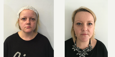 45-54 year old woman treated with Silhouette Soft - this patient had a jaw and neck treatment to define her jaw line and an eyebrow lift using Silhouette Soft sutures