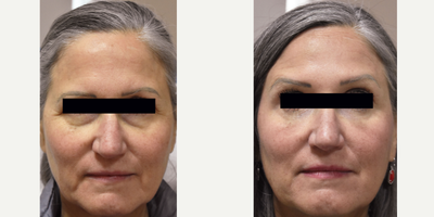 Turn back the clock 10 years.  Dark Circles Under the Eyes - How would turning back the clock 10 years in less than 30 minutes feel.  We bet pretty great.  You don't have to undergo surgery to look younger.  Call us today to learn more about laser and injection procedures.