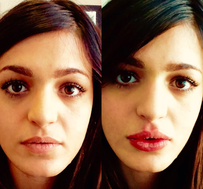 18-24 year old woman treated with Belotero - Belotero for lip enhancement.