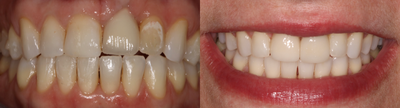 25-34 year old woman treated with Dental Implants - Smile makeover with Invisalign, and implant crown.The dentistAnnese had patient in orthodontics for 10 weeks to correct bite and fix esthetic enhancement to replace Implant and old implant crown.