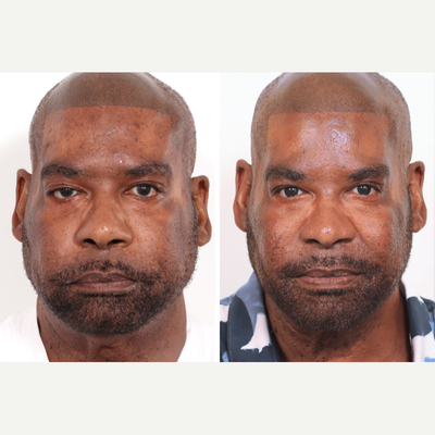 55-64 year old man treated with Ptosis Surgery, Eyelid Surgery - Male patient seen 6 months after a Ptosis & Upper lid Blepharoplasty