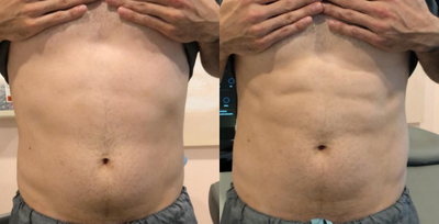 Emsculpt - The doctor loves the Emsculpt treatment so much that he decided to do a series of them. These photos are taken after one treatment, stay tune to see the rest of the before and after photos