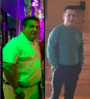 45-54 year old man treated with Orbera Intragastric Balloon - Male patients have great success losing weight with Orbera Balloon. This patient achieved his goal weight with the help of balloon and nutritional coaching.