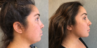 25-34 year old woman treated with Chin Liposuction - Chin Liposuction