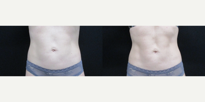 More defined abdomen from Cooltone - Directly after 4 sessions of Cooltone. 4 sessions is the amount typically needed for a full treatment.