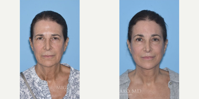 Woman treated with Lip Lift - Woman treated with Facelift, Neck Lift, Brow Lift, Eyelid Surgery, and Lip Lift