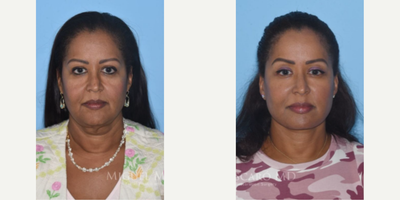 Woman treated with Facelift - Woman treated with Deep Plane Facelift, Neck Lift, and Facial Fat Transfer. Patient is shown before and 10 months post-op.