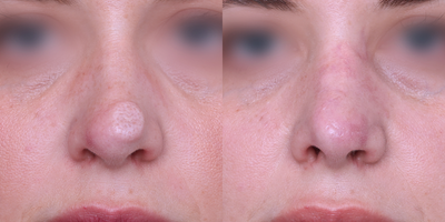 35-44 year old woman treated with mole/scar removal via excision - Take a look as Dr. Khorasani removes this patients mole and then does scar resurfacing with dermabrasion, deepfx, and vascular laser: https://www.youtube.com/shorts/ke4ZouXehI8