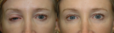 Right upper eyelid ptosis repair - A droopy eyelid is not only a cosmetic issue. It can also cause decreased visual fields. This patient's upper eyelid ptosis was repaired via an internal approach: by flipping the eyelid, the muscle was tightened without needing any skin incision.