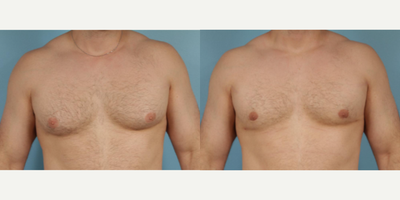 Man treated with Gynecomastia Surgery - Man treated with Gynecomastia Surgery