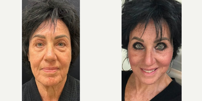 65-74 year old woman treated with Facelift, Deep Plane Facelift, Eyelid Surgery - 65 y.o female who underwent awake deep plane facelift, neck lift, upper and lower blepharoplasty and facial fat transfer. She was awake yet comfortable for the procedure