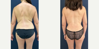 MOMMY MAKEOVER - 360 LIPOSUCTION WITH FAT TRANSFER AREOLA REDUCTION WITH FAT TRANSFER TO CLEAVAGEABDOMINOPLASTY