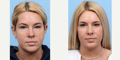 25-34 year old woman treated with Eyelid Surgery - Dr. Wise performed a lower transconjunctival blepharoplasty to remove this patient's undereye bags.
