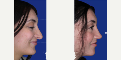 25-34 year old woman treated with Revision Rhinoplasty - 25-34 year old woman treated with Revision Rhinoplasty