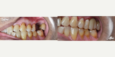 55-64 year old man treated with Dental Implants, Dental Crown, Dental Bone Graft - This patient broke him tooth and i remove the tooth, i did a dental implants, bone graft and crown.