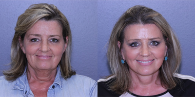 45-54 year old woman treated with Lifestyle Lift - Patient had Lifestyle Lift, Upper and Lower Bleph, Fat Transfer, and Brow Lift