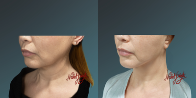 35-44 year old woman treated with Thermage FLX - 35-44 year old woman treated with Thermage FLX
