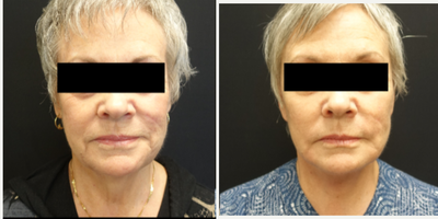 55-64 year old woman treated with Neck Lift - Patient underwent a high lateral SMAS face and neck lift with platysma band plication and facial fat grafting.  The combination of all these techniques give her a dramatic difference in her neck while still maintaining a natural appearance to the face overall.  The fat grafting restores the volume that patients lose over time as they age. The combination of the fat transfer and facelift give patients a more natural and youthful appearance.