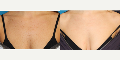 35-44 year old woman treated with Halo Laser - This patient underwent a combo treatment of Broad Band Light and Halo Laser to remove unwanted sun spots from her chest.