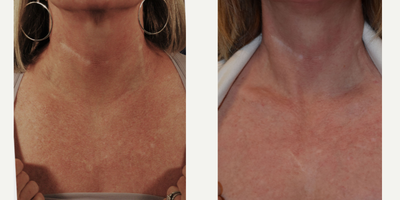Los Angeles Laser Treatment for Decollete - Poikiloderma treatment for the decollete. Before and after photos for chest discoloration.