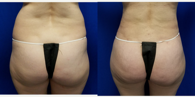 25-34 year old woman treated with Liposculpture - 37 year old female who had liposuction of the back and abdomen with fat transfer to the buttocks. Liposuction was performed using Vaser and Power Assisted Liposuction. A total of 3.5 Liters was removed with 1 liter from the lower back. 750cc's was placed in each buttock. The patient's height is 5 foot 3 inches. Her weight was 134 lbs. She has two children.