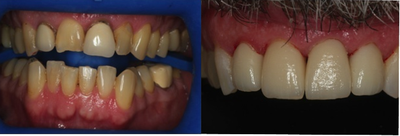 Dental Veneers - 
	Replace your Old crowns..Make them look like teeth again.