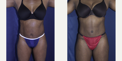25-34 year old woman treated with Tummy Tuck - (30s YO) This 52 African American female did not have a lot of loose skin but she wanted a tummy tuck to tighten her stomach area. Dr. Rodriguez also extracted approximately 900 cc of fat with liposuction.