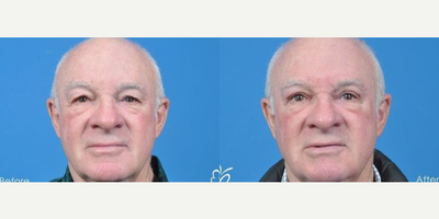 Man treated with Eyelid Surgery - Man treated with Eyelid Surgery