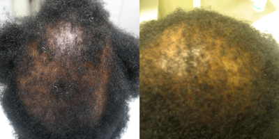 45-54 year old woman treated with Hair Loss Treatment - PRP with microneedling of scalp. Hair follicle rejuvenation.