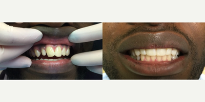 35-44 year old man treated with Porcelain Veneers - 30 something year old male with crooked front tooth and small lateral incisor and canine. After 6 porcelain veneers and only 2 appointments with Dr. Thompson, patient has a perfect smile and a drastically improved look that should last him the next 30 years.