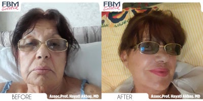 65-74 year old woman treated with Deep Plane Facelift, Neck Lift, Double Eyelid Surgery - 65-74 year old woman treated with Deep Plane Facelift, Neck Lift, Double Eyelid Surgery