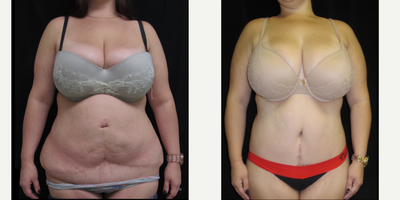 25-34 year old woman treated with Tummy Tuck Revision - This 30 year old female is now 10 months postop after abdominoplasty revision for a considerable deformity acquired at the hands of another plastic surgeon who was not board certified by the American Board of Plastic Surgery (ABPS).