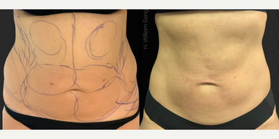 Woman treated with truFlex - 6-month post-op results of our client that received Power-Assisted Liposuction combined with TruSculpt Flex.With the most advanced technology & artistry, we helped her achieve her summer-ready body goals. With Power-Assisted Liposuction, excess stubborn fat was removed, revealing contoured curves and enhancing her natural silhouette.But the transformation didn't stop there! We took it a step further with TruSculpt Flex, the finishing touch that added the perfect tone and definition to her newly sculpted body. TruSculpt Flex is a personalized muscle sculpting device to tighten, tone, and strengthen your muscles based on your fitness levels & goals.