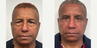 45-54 year old gender nonconforming person treated with Eyelid Surgery - 6 weeks after an upper and lower blepharoplasty