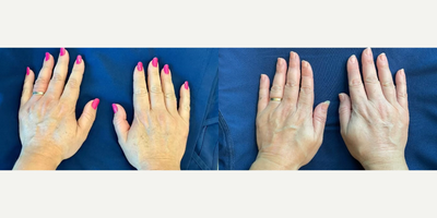 Woman treated with Lumecca - A very special client came in for Lumecca of the hands three weeks ago. As you can see she no longer has any dark spots!