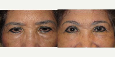 65-74 year old woman treated with Asian Eyelid Surgery - Patient s/p browlift and bilateral upper eyelid ptosis repair with blepharoplasty