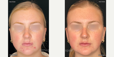 18-24 year old woman treated with AviClear - Progress photos after 3 sessions of AviClear. Full results at 6-12months.
