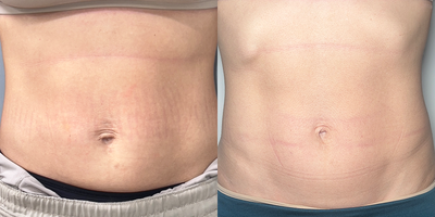 Morpheus8 Body for Abdomen - Morpheus8 is a transformative body treatment specifically designed for the abdomen, using fractional radiofrequency energy to penetrate deeply and remodel the skin and fat. This technique tightens loose skin, reduces fat, and enhances the overall contour of the abdomen, resulting in a firmer, more sculpted appearance.