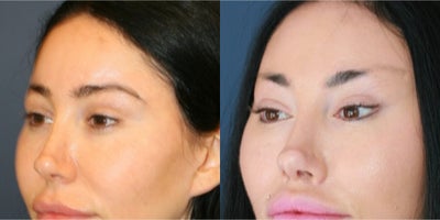 35-44 year old woman treated with Canthoplasty, Eyelid Surgery - Before and two years after Bratz blepharoplasty, Feel Beautiful Plastic Surgery