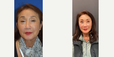 55-64 year old woman treated with Eyelid Surgery - Before and After: Upper and Lower Blepharoplasty by Dr. Almonte