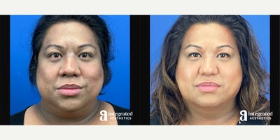35-44 year old woman treated with AccuTite, Thread Lift, Facial Fat Transfer, Rhinoplasty, Buccal Fat Removal - The patient is a 42-year-old transgender female who has concerns with the appearance of her lower, face, neck, and nose. Dr. Cho performed Accutite and MyEllevate to the lower face and neck, fat grafting to the face, Alar Width and Internal Nare Reduction to the nostrils, and buccal fat removal. The after results are 4 months post-procedure.