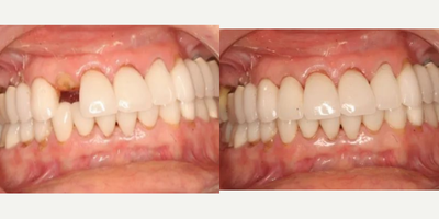 Patient treated with Dental Crown - Oops, dental emergency? No worries. Empower Your Smile is here with prompt solutions, offering crowns to restore your smile!