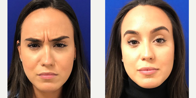 25-34 year old woman treated with Injectable Fillers - My 25 year old patient 2 weeks post Botox to the glabella (11) lines and Juvederm lip filler.