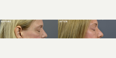 Woman treated with Brow Lift, Eyelid Surgery - Endoscopic Brow Lift + Blepharoplasty, our patient who underwent a rejuvenating transformation by Dr. Marotta!The patient had concerns such as upper eyelid skin excess, heaviness, lower eyelid skin excess, a hollow look, descent of the brow, and an overall tired appearance.An endoscopic brow lift addressed brow descent, providing a natural lift. Upper blepharoplasty targeted excess skin, creating a more youthful upper eyelid appearance. Laser treatment enhanced skin texture, while fat transfer added volume to achieve a rejuvenated, non-hollow look. A lower lid skin pinch ensured a smooth and refreshed lower eyelid contour. The after images speak volumes a refreshed, lifted brow, vibrant eyes, and a harmonious periorbital region. Our patient radiates confidence and a revitalized glow!