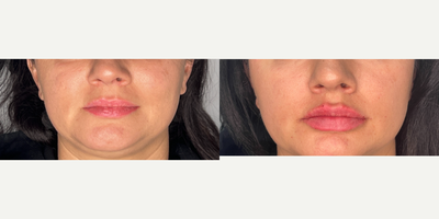 25-34 year old woman treated with Lip Fillers, Juvederm - pt treated with juvederm for lip augmentation