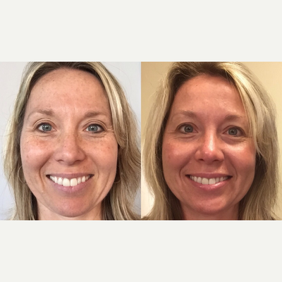 45-54 year old woman treated with Vi Peel - Vi Peel is the first medical peel that synergistically combines major acids in a pain-free formulation, launching the next generation of chemical peels. VI Peels are a safe, effective approach to achieving younger looking skin and is safe for all skin types. See significant reversal of sun damage, hyper pigmentation including melasma, acne & acne scarring, and aging skin.