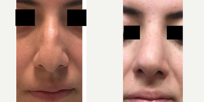 18-24 year old man treated with Nose Surgery - Rhinoplasty: very uneven and lobulated dorsum that was corrected with some increase in tip definition. Still with some swelling.&nbsp;The dorsal skin will shrink wrap and begin to look nice within the next month. She is currently 3 months post op.