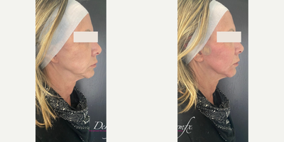 35-44 year old woman treated with Thread Lift, Contour Thread Lift - Threads are resorbable surgical sutures composed of biodegradable polymers. The treatment is minimally invasive and produces instant results. Polydioxanone (PDO) sutures are used for biomedical applications, particularly in cardiothoracic surgery because it is fully absorbed by hydrolysis within 4 to 6 months and doesnt create any scar tissue. The foreign body stimulates collagen synthesis and the skin structure created will hold for 12 to 15 months.Can be used for :-Eye Lift-Full Face-Neck-Rhinoplasty-Upper/Lower
