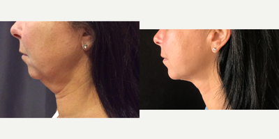 58 year old woman treated with Ultherapy - Ultherapy non surgical lift for lower face and neck.